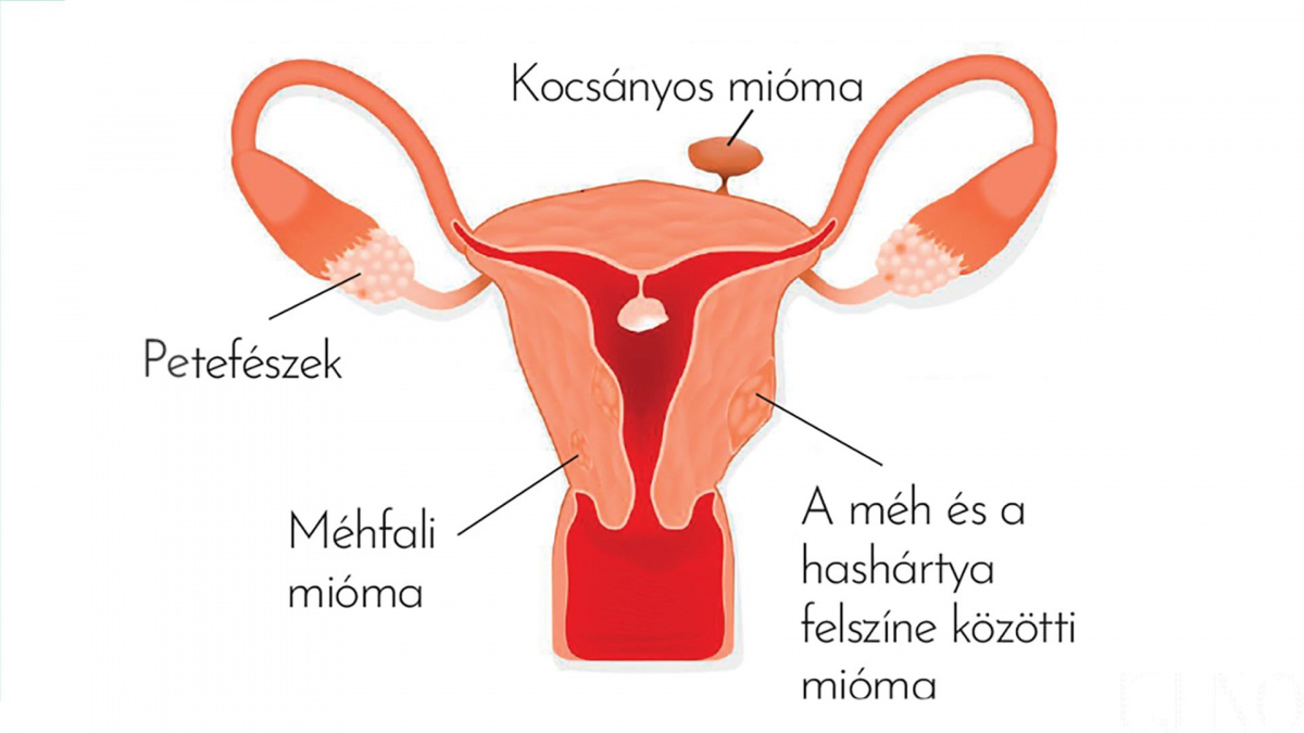 mitol-alakul-ki-a-mioma-magyarazat_0.jpg